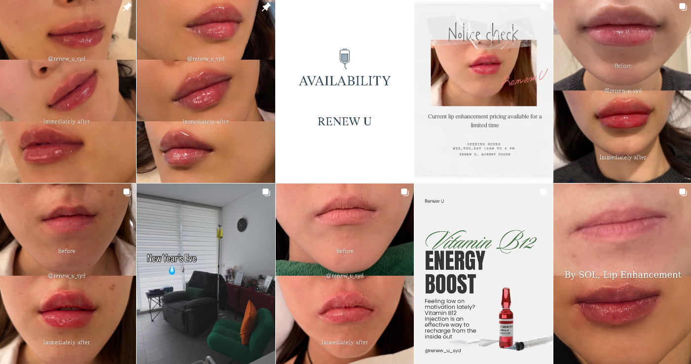 Lip enhancement treatment